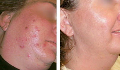 Before and after of Michele Corley client using  home care products recommended for oily/combination acne with underlying congestion and pih.