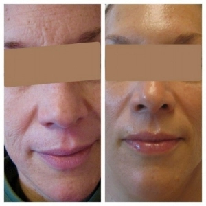 Before and after of Michele Corley client using home care products recommended for extremely dry, dehydrated skin.