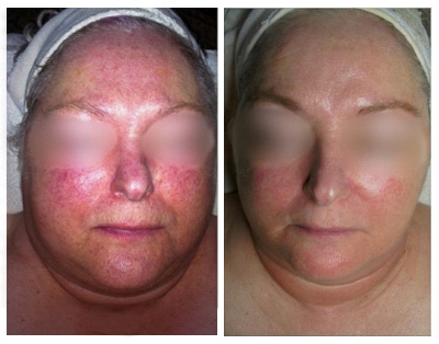 Before and after of Michele Corley client using home care products recommended for environmental damage, rosacea, sensitive and capillary activity.
