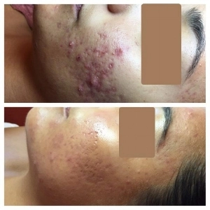 Before and after of Michele Corley client using home care products recommended for oily/combination acne with underlying congestion and pih.