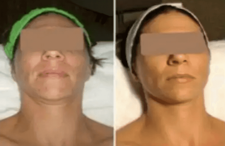 Before and after of Michele Corley client using home care products for combination, congested skin exhibiting PIH.
