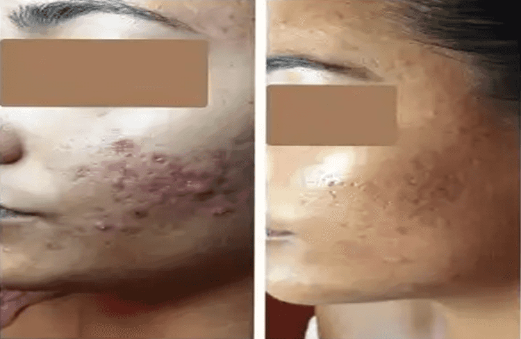 Before and after of Michele Corley client using home care products for oily/combination acne with underlying congestion & PIH.