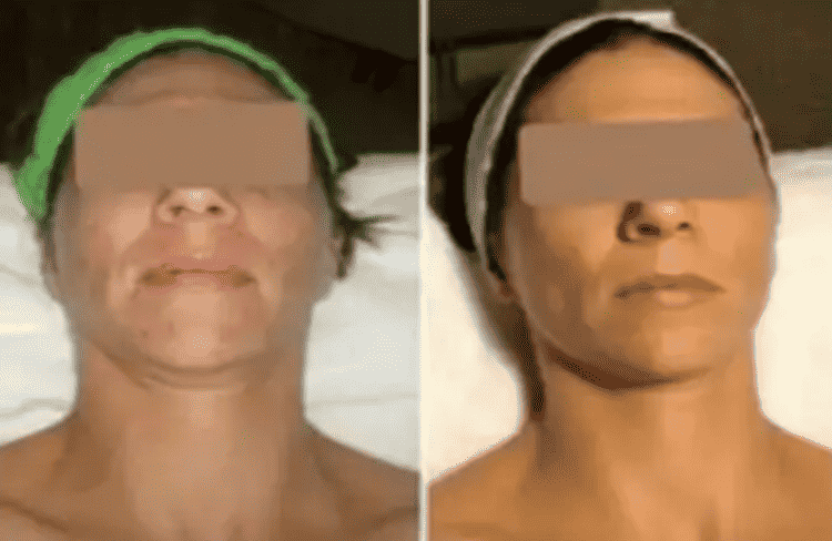 Before and after of Michele Corley client using home care products recommended for combination, congested skin exhibiting post inflammatory hyperpigmentation