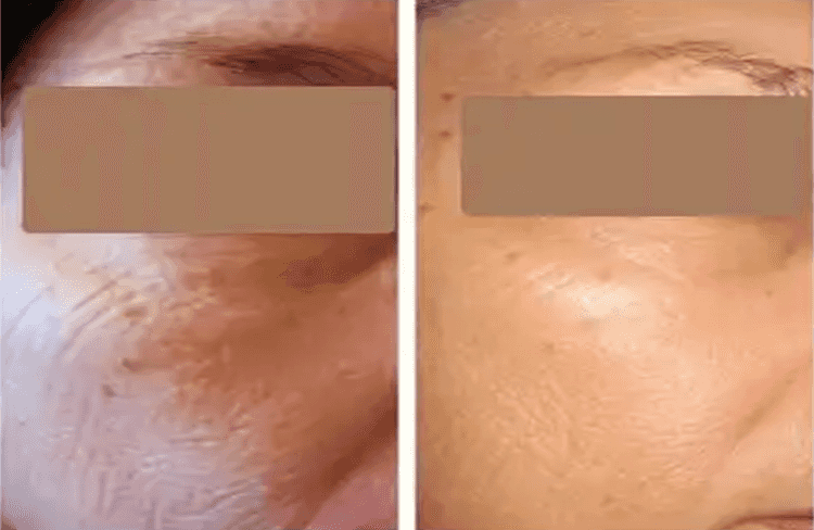 Before and after of Michele Corley client using home care products for extremely dry, dehydrated, environmentally damaged skin.
