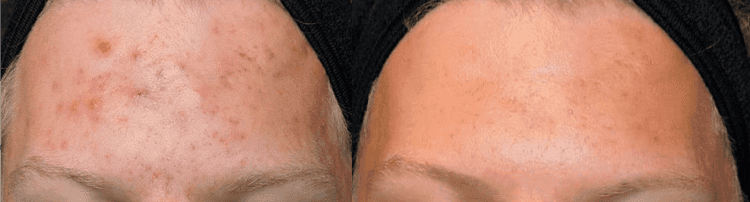 Before and after of Michele Corley client using home care products for acne.