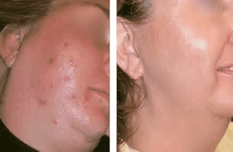 Before and after of Michele Corley client using home care products for oily/combination acne with underlying congestion & PIH.