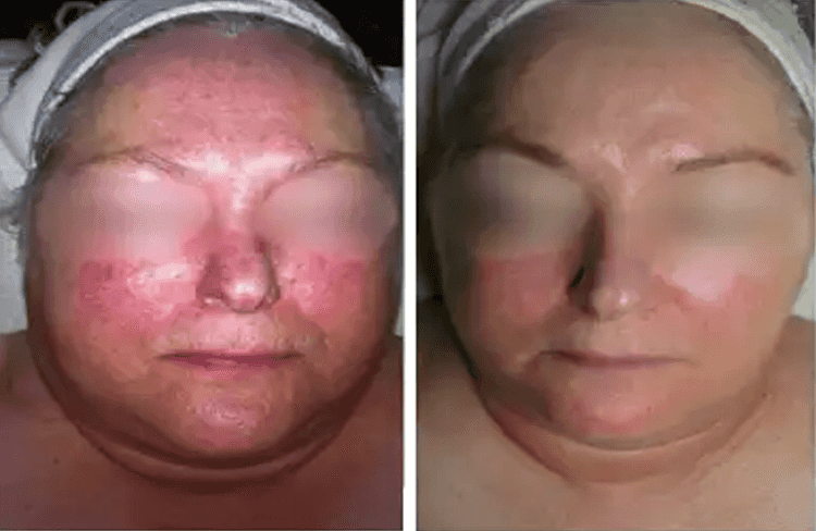 Before and after of Michele Corley client using home care products for environmental damage, rosacea, sensitive & capillary activity.