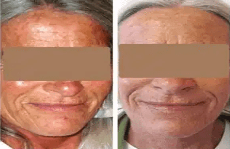 Before and after of Michele Corley client using home care products for dry, sensitive, environmentally damaged skin.