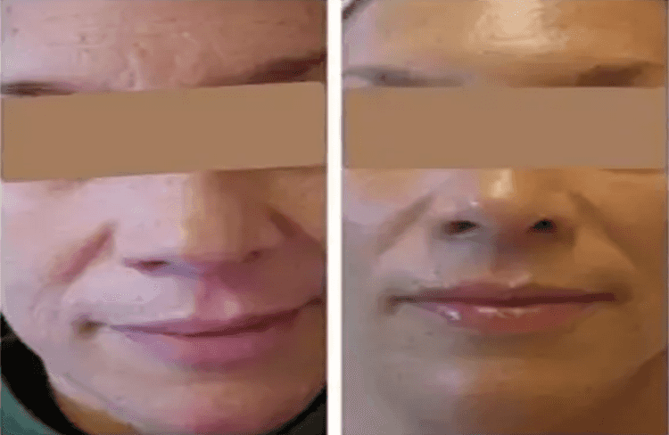 Before and after of Michele Corley client using home care products for extremely dry, dehydrated skin.